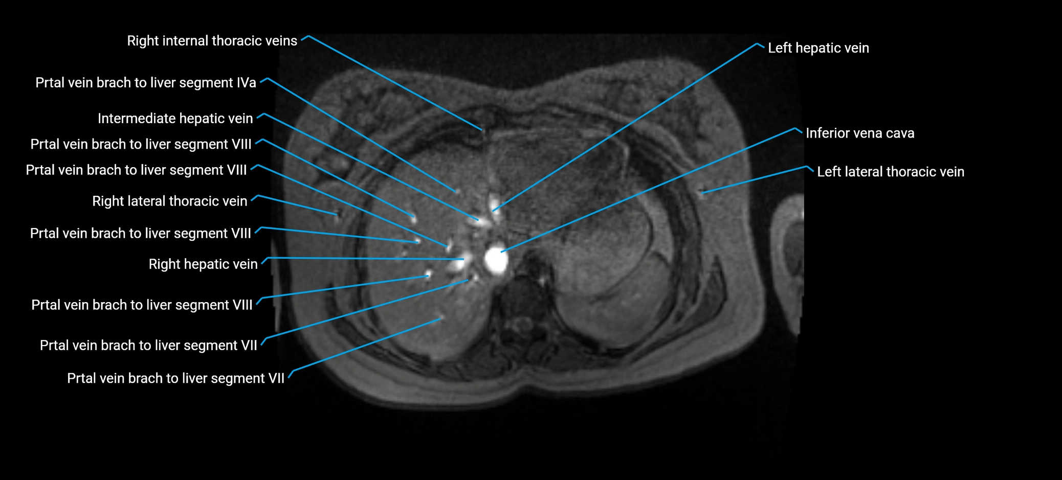 MRV abdomen pelvis & lower limb axial cross sectional anatomy labelled MRI image 24 (1).webp